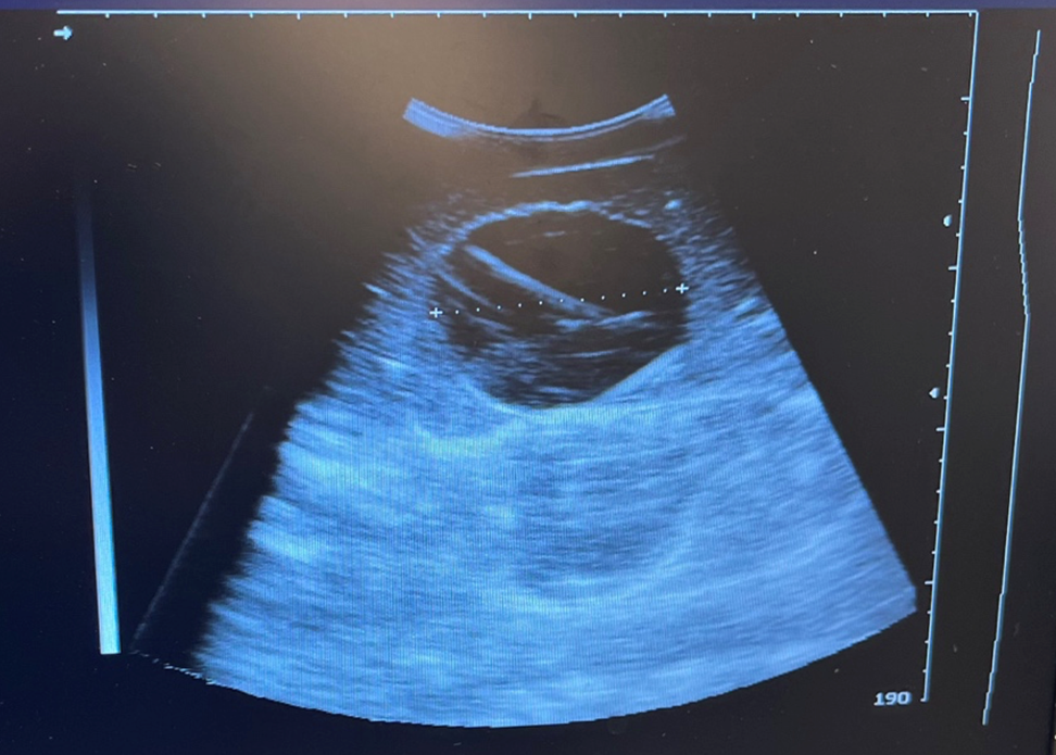 Low-Cost Cardiac Ultrasound Phantom