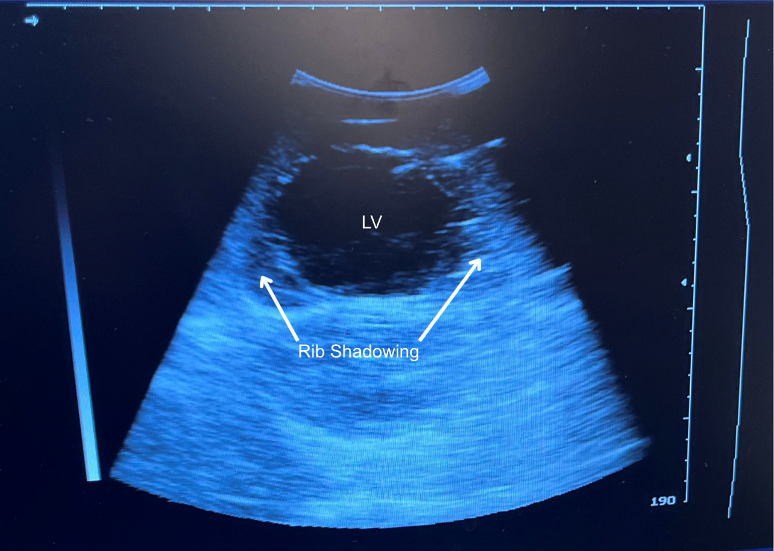 Ultrasound of Phantom